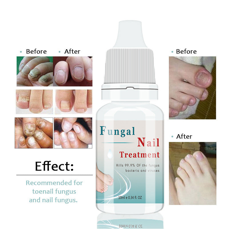 Fungal Nail Treatment – Repair, Strengthen, and Protect Your Nails