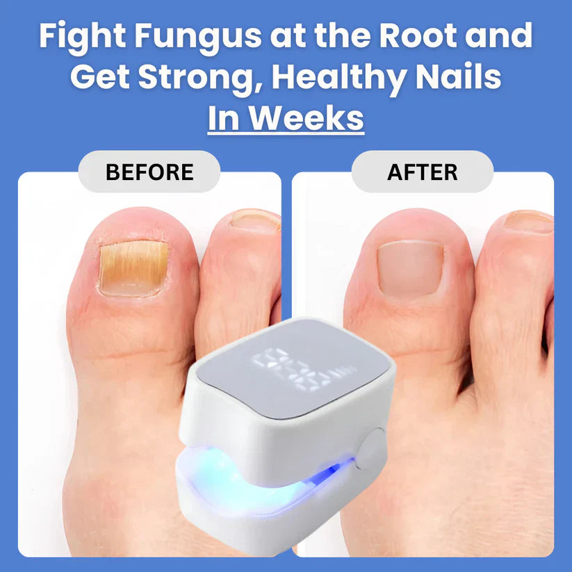 laser treatment for nail fungus