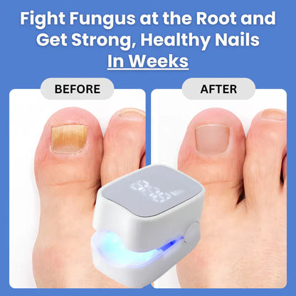 laser treatment for nail fungus
