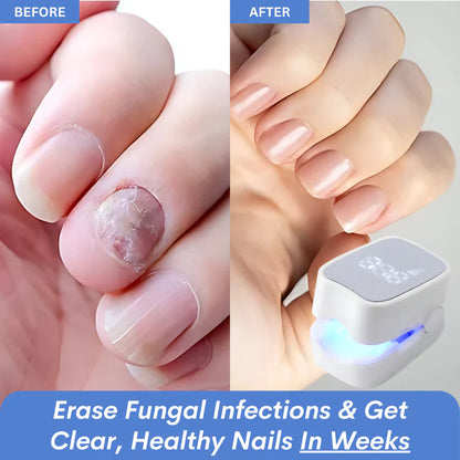 sassytip™ laser device and reclaim your clear nails